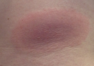 Erythema migrans in the lumbar region (Enlarges Image in Dialog Window)